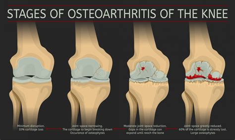 Pathophysiology Of Knee Osteoarthritis | The Best Porn Website