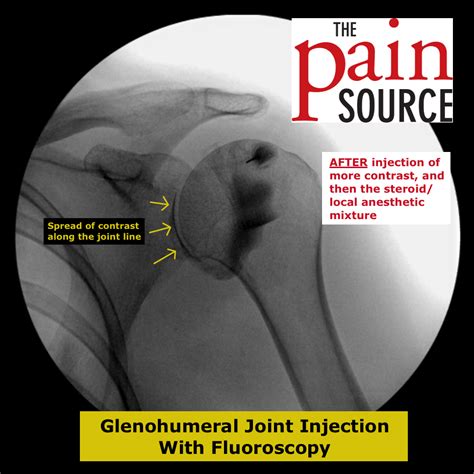 Icd 10 Code For Left Adhesive Capsulitis Of The Shoulder