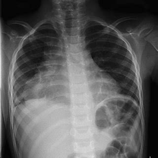 Chest X-ray showing right perihilar and right lower zone opacity... | Download Scientific Diagram