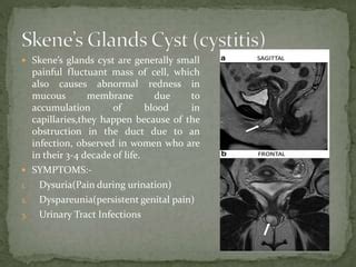 Skene’s gland anatomy and regulations and features | PPT