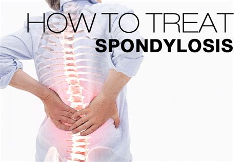 Spondylosis: Symptoms, Causes, Treatment By Back Braces