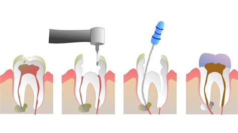 What is Root Canal Treatment and What is the Procedure? - Smile Delivery Online