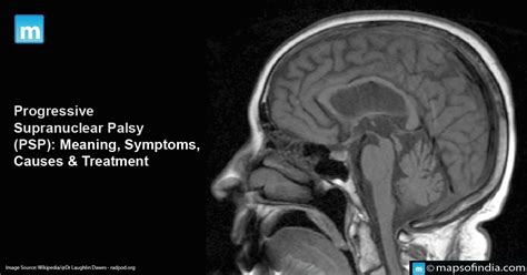 Progressive Supranuclear Palsy: Meaning, Symptoms, Causes & Treatment - Health