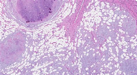 Hamartoma | MiInformePatología.ca