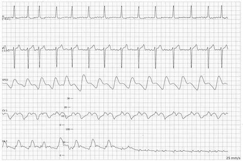 Pulmonary Artery Wedge Waveform