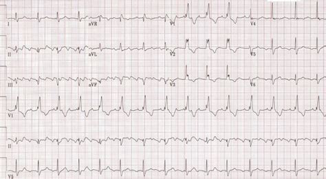 Atrial flutter EKG examples - wikidoc