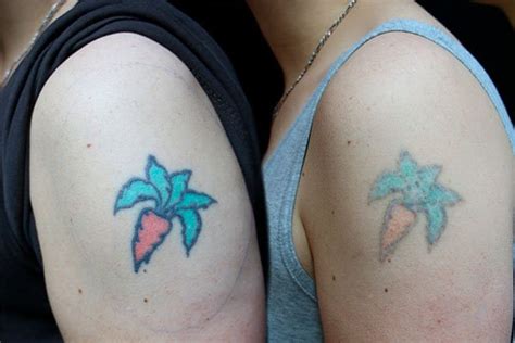 Borrar tatuajes con láser - de 5 a 15 sesiones necesarias - Salud y ...