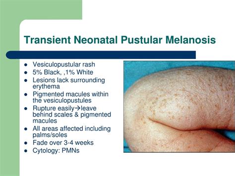 Erythema Toxicum Vs Pustular Melanosis