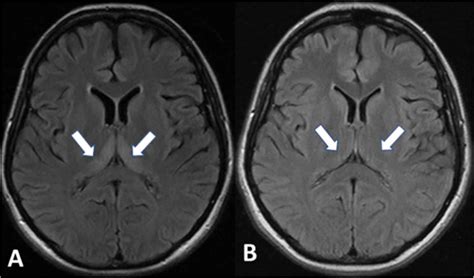 Wernicke's encephalopathy causes, symptoms, diagnosis, treatment & prognosis