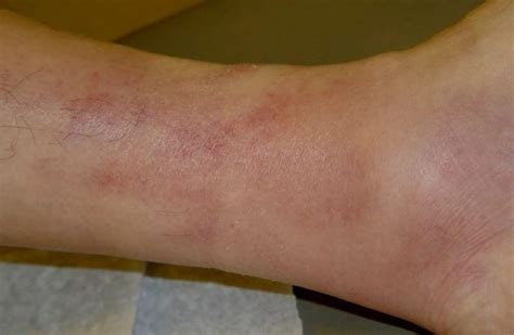 Superficial thrombophlebitis pictures | Symptoms and pictures