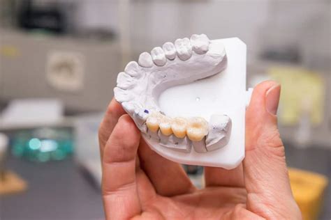 What to Expect During the Dental Bridge Procedure