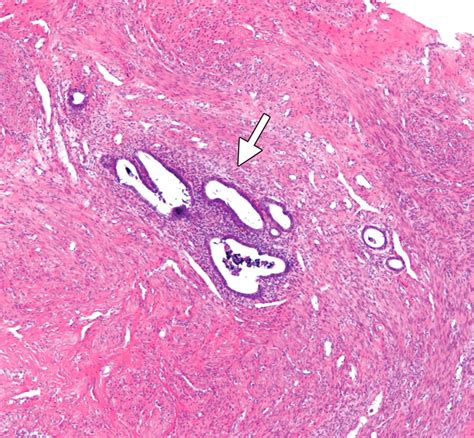 Adenomyosis: Usual and Unusual Imaging Manifestations, Pitfalls, and ...