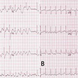 (PDF) Severe hypermagnesemia presenting with abnormal ...