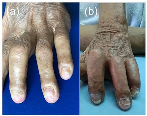 Evolution of lesions with clobetasol propionate 0.05% ointment. (a ...