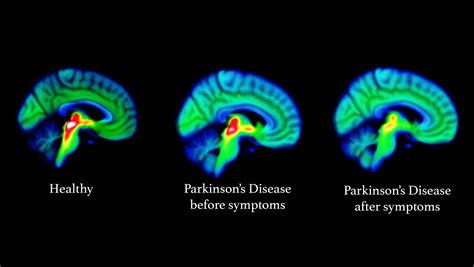 Parkinson's Disease Brain Malfunction Evident in Scans Potentially Years Before Symptoms