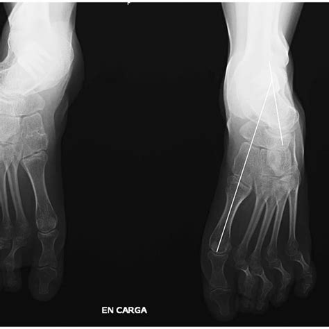 Severe cavovarus deformity treated by Tarsal osteotomy. | Download Scientific Diagram