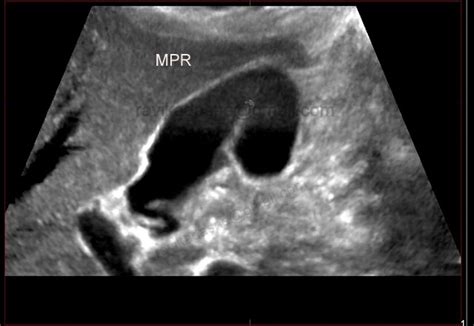 Folded Gallbladder-Ultrasound - Sumer's Radiology Blog