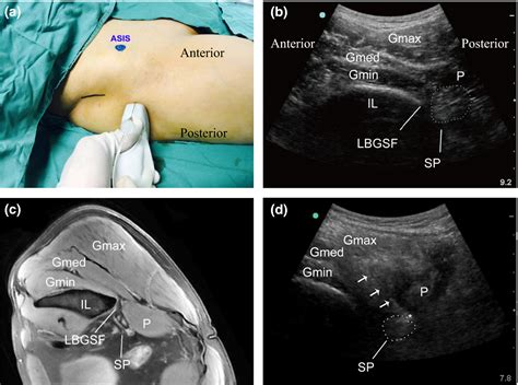 Lumbar Plexus Block