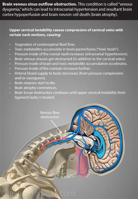 Internal Jugular Vein