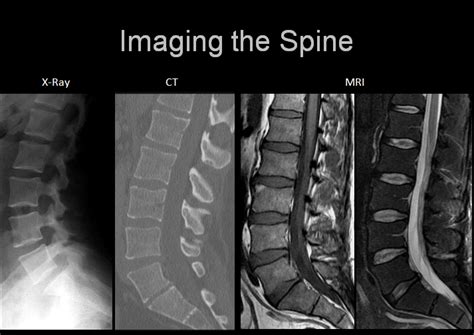 Cervical Spine X Ray Vs Mri The Mayfair Clinic Images