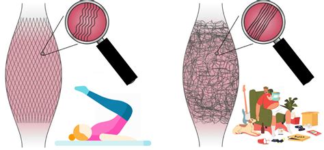 Fascia Explained: The link between fascia and chronic pain