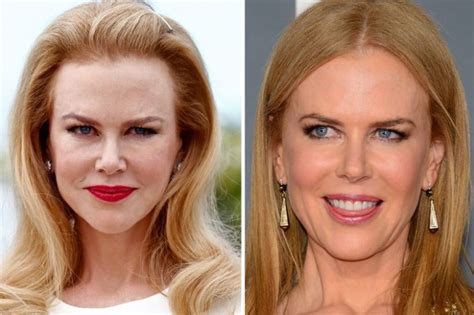 nicole kidman botox – TheCount.com