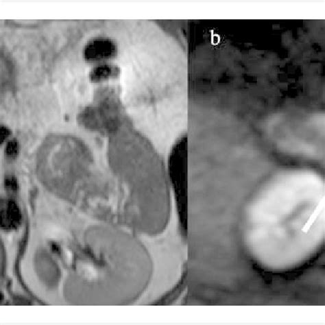 MRI scans in T2 (a) and DWI (b) modes. Insulinoma of pancreatic ...