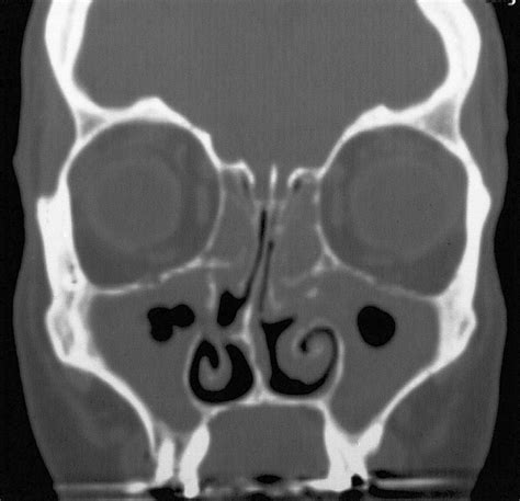 Coronal CT scan of patient #2 showing complete ethmoid opacification... | Download Scientific ...