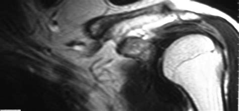 Supra clavicular mass – Radiopaedia