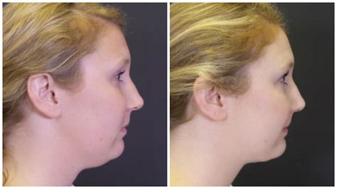 How to Get Rid of a Double Chin: 19 Facts About Chin & Facial Liposuction