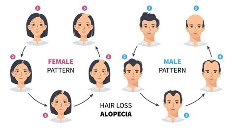 Hair loss stages, androgenetic alopecia male and female pattern. Steps ...