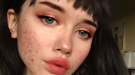 Blogger With Acne Shares Makeup-Free Selfies and Messages of Support | Allure