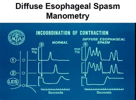 Esophagus Disorders II Flashcards | Quizlet
