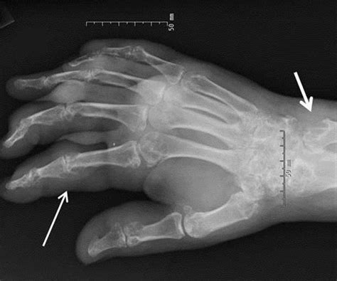 Gout Vs Pseudogout Crystals