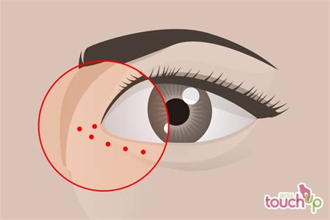 Epicanthoplasty Lateral Canthoplasty Korea | Seoul TouchUp