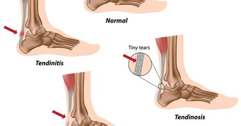 Achilles tendinosis and tendinitis: Signs, symptoms and treatment options | Dr Geier