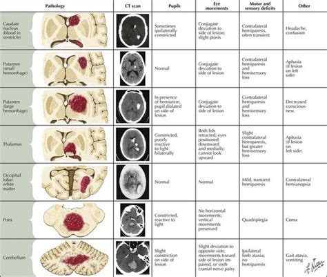 Intracerebral Hemorrhage | Neupsy Key