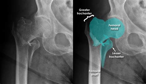 Trauma X-ray - Lower limb gallery 1 - Hip - Extra-capsular fractures