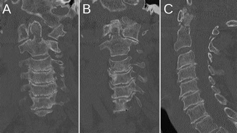 Type 2 Dens Fracture