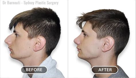 Plastic Surgery Before And After Nose Jobs