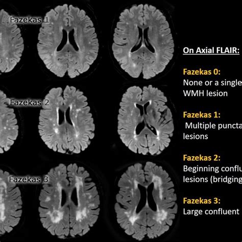 Diffuse brain atrophy in a hypertensive patient. Axial T2WI shows ...