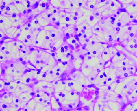 Clear cell RCC, representative histology (H&E). | Download Scientific Diagram