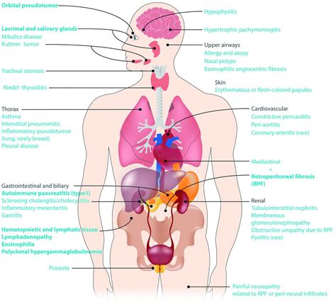 IgG4-related disease: what a hematologist needs to know | Haematologica