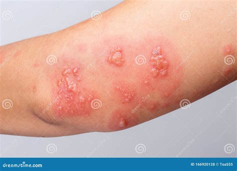 Shingles (herpes Zoster) Blister Skin Rash Royalty-Free Stock ...