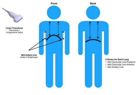 PEM Pearls: Pediatric Lung Ultrasound for Diagnosing Pneumonia | The Wave of the Future