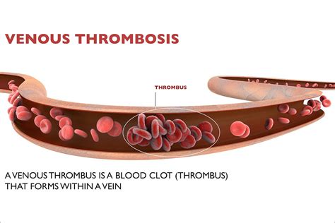 Deep Venous Thrombosis And Doppler Ultrasound - Sergio Mazzei