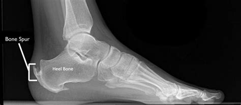 Bone Spurs usually in a joint. Can be especially painful when on the heel. Learn what causes ...