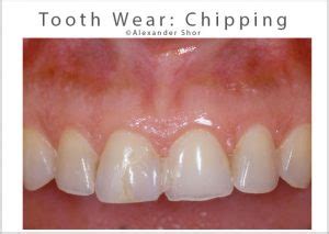 Tooth Wear Treatment Seattle - Shor Dental