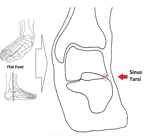 What is Sinus Tarsi Pain? Ankle and Foot Centre