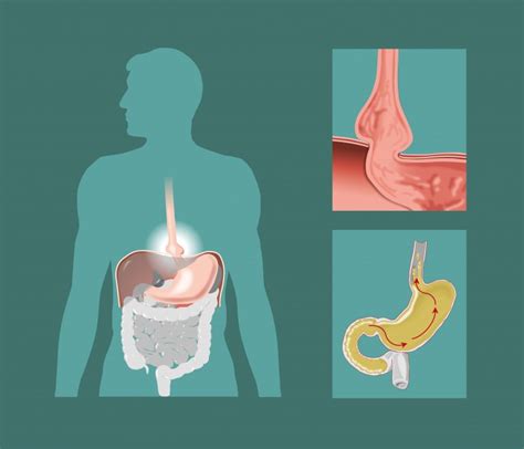 Basic Hernia | Premier Hernia Center